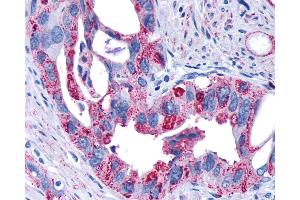 Anti-FZD4 / Frizzled 4 antibody IHC of human Pancreas, Carcinoma. (FZD4 anticorps  (N-Term))