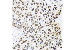 Immunohistochemistry of paraffin-embedded human lung cancer using FUBP1 antibody (ABIN5973257) at dilution of 1/100 (40x lens). (FUBP1 anticorps)
