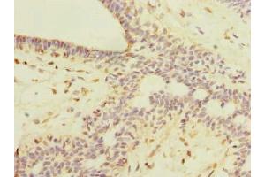 Immunohistochemistry of paraffin-embedded human breast cancer using ABIN7168420 at dilution of 1:100 (ROPN1L anticorps  (AA 1-230))