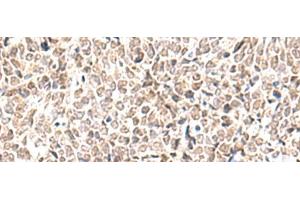 Immunohistochemistry of paraffin-embedded Human lung cancer tissue using EWSR1 Polyclonal Antibody at dilution of 1:70(x200)