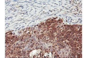 Immunohistochemical staining of paraffin-embedded Adenocarcinoma of Human ovary tissue using anti-NLN mouse monoclonal antibody. (NLN anticorps)