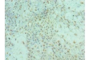 Immunohistochemistry of paraffin-embedded human breast cancer using ABIN7143956 at dilution of 1:100 (ALS2 anticorps  (AA 1-280))