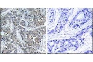 Immunohistochemistry analysis of paraffin-embedded human breast carcinoma tissue, using Stathmin 1 (Ab-15) Antibody. (Stathmin 1 anticorps  (AA 5-54))