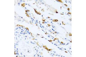 Immunohistochemistry of paraffin-embedded human lung cancer using SFTPC antibody. (Surfactant Protein C anticorps)