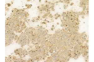 ABIN6259687 and ABIN6279169 at 1/100 staining human melanoma by IHC-P.