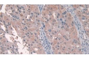 Detection of PCI in Human Breast cancer Tissue using Polyclonal Antibody to Protein C Inhibitor (PCI)