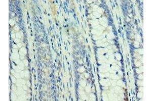 Immunohistochemistry of paraffin-embedded human colon cancer using ABIN7160232 at dilution of 1:100