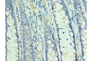 Immunohistochemistry of paraffin-embedded human colon cancer using ABIN7160232 at dilution of 1:100 (SMAD3 anticorps  (AA 1-230))