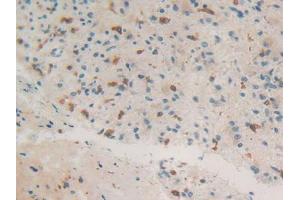 IHC-P analysis of Human Glioma Tissue, with DAB staining. (Coronin 1a anticorps  (AA 7-204))