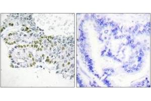 Immunohistochemistry analysis of paraffin-embedded human lung carcinoma, using PKC delta (Phospho-Tyr52) Antibody. (PKC delta anticorps  (pTyr52))