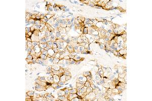 Immunohistochemistry of paraffin-embedded Human hepatocellular carcinoma using CE antibody (ABIN7266084) at dilution of 100 (40x lens).