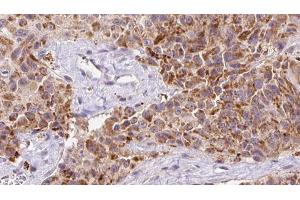 ABIN6273147 at 1/100 staining Human Melanoma tissue by IHC-P. (Osteocalcin anticorps  (Internal Region))