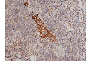 ABIN6255334 and ABIN6267311 at 1/200 staining human breast cancer tissue sections by IHC-P.