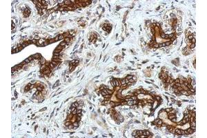 IHC-P Image Immunohistochemical analysis of paraffin-embedded human breast cancer, using Glycine Receptor alpha 2, antibody at 1:750 dilution. (GLRa2 anticorps)