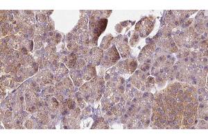 ABIN6273276 at 1/100 staining Human pancreas cancer tissue by IHC-P. (NSDHL anticorps  (Internal Region))