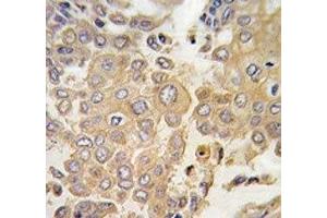 IHC analysis of FFPE human lung carcinoma tissue stained with MAPK4 antibody (MAPK4 anticorps  (AA 72-101))