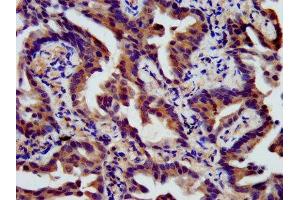 IHC image of ABIN7165980 diluted at 1:400 and staining in paraffin-embedded human lung cancer performed on a Leica BondTM system. (SSH3 anticorps  (AA 480-659))