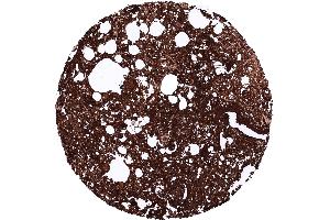 Pancreatic ductal adenocarcinoma with strong CA19 9 staining of all tumor cells