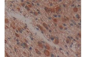 Detection of APOA1BP in Human Glioma Tissue using Polyclonal Antibody to Apolipoprotein A1 Binding Protein (APOA1BP)