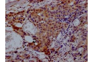 IHC image of ABIN7127867 diluted at 1:100 and staining in paraffin-embedded human breast cancer performed on a Leica BondTM system. (Recombinant VCP anticorps)