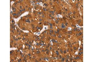Immunohistochemistry of Human gastric cancer using MT-CYB Polyclonal Antibody at dilution of 1:50 (Cytochrome b anticorps)