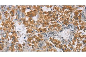 Immunohistochemistry of paraffin-embedded Human thyroid cancer tissue using DIO1 Polyclonal Antibody at dilution 1:60