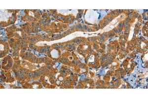 Immunohistochemistry of paraffin-embedded Human thyroid cancer tissue using EPHB3 Polyclonal Antibody at dilution 1:40 (EPH Receptor B3 anticorps)
