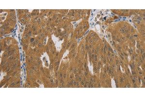 Immunohistochemistry of paraffin-embedded Human ovarian cancer using NIT2 Polyclonal Antibody at dilution of 1:40 (NIT2 anticorps)