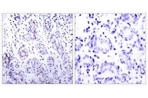 Immunohistochemical analysis of paraffin-embedded human breast carcinoma tissue using STAT3 (Ab-727) antibody (E021046). (STAT3 anticorps)