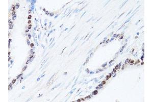 Immunohistochemistry of paraffin-embedded human colon carcinoma using SQSTM1 antibody. (SQSTM1 anticorps  (AA 1-440))