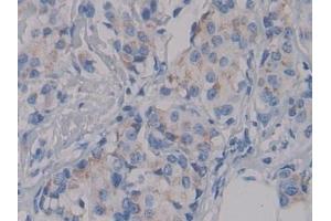 Detection of NPHN in Human Breast cancer Tissue using Polyclonal Antibody to Nephrin (NPHN)