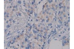 Detection of NPHN in Human Breast cancer Tissue using Polyclonal Antibody to Nephrin (NPHN) (Nephrin anticorps  (AA 23-92))