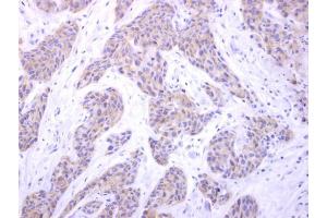 IHC-P Image PIGK antibody [N1C2] detects PIGK protein at cytosol on human breast carcinoma by immunohistochemical analysis.