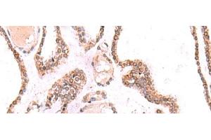 Immunohistochemistry of paraffin-embedded Human thyroid cancer tissue using TOR1AIP1 Polyclonal Antibody at dilution of 1:70(x200) (TOR1AIP1 anticorps)