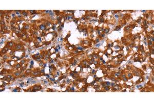 Immunohistochemistry of paraffin-embedded Human thyroid cancer tissue using GAGE12I Polyclonal Antibody at dilution 1:30 (G Antigen 12I anticorps)