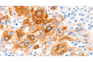 Immunohistochemistry of paraffin-embedded Human cervical cancer tissue using SLC2A11 Polyclonal Antibody at dilution 1:140 (SLC2A11 anticorps)