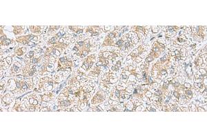 Immunohistochemistry of paraffin-embedded Human liver cancer tissue using NDRG4 Polyclonal Antibody at dilution of 1:45(x200)