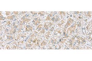 Immunohistochemistry of paraffin-embedded Human liver cancer tissue using NDRG4 Polyclonal Antibody at dilution of 1:45(x200) (NDRG4 anticorps)