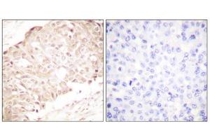 Immunohistochemistry analysis of paraffin-embedded human breast carcinoma tissue using SENP1 antibody. (SENP1 anticorps  (N-Term))