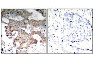Immunohistochemical analysis of paraffin-embedded human breast carcinoma tissue using IkB-ε (Ab-22) antibody (E021296). (NFKBIE anticorps)
