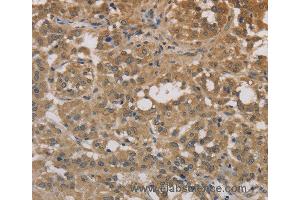 Immunohistochemistry of Human liver cancer using DEGS1 Polyclonal Antibody at dilution of 1:30 (DEGS1 anticorps)