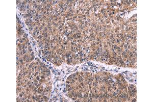 Immunohistochemistry of Human colon cancer using EFNA5 Polyclonal Antibody at dilution of 1:40 (Ephrin A5 anticorps)