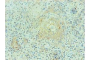 Immunohistochemical of paraffin-embedded human breast cancer using ABIN7168560 at dilution of 1:200 (S1A9 anticorps)