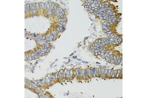 Immunohistochemistry of paraffin-embedded human colon carcinoma using ND5 antibody (ABIN5975833) at dilution of 1/100 (40x lens). (MT-ND5 anticorps)