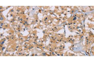 Immunohistochemistry of paraffin-embedded Human thyroid cancer using ACTN4 Polyclonal Antibody at dilution of 1:60 (alpha Actinin 4 anticorps)