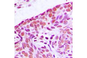Immunohistochemical analysis of MEKK3 staining in human breast cancer formalin fixed paraffin embedded tissue section. (MAP3K3 anticorps  (Center))