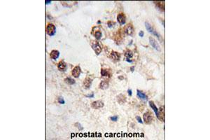 Formalin-fixed and paraffin-embedded human prostate carcinoma tissue reacted with KLF4 polyclonal antibody  , which was peroxidase-conjugated to the secondary antibody, followed by DAB staining. (KLF4 anticorps  (N-Term))