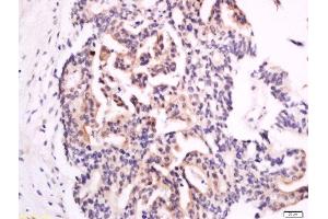Formalin-fixed and paraffin embedded human colon carcinoma labeled with Anti-XTP4 Polyclonal Antibody, Unconjugated  at 1:300 followed by conjugation to the secondary antibody and DAB staining. (C17orf37 anticorps  (AA 10-60))
