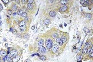 Immunohistochemistry (IHC) analyzes of p-p70 S6 kinase alpha antibody in paraffin-embedded human breast carcinoma tissue. (RPS6KB1 anticorps  (pSer434))
