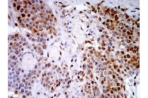 Immunohistochemical analysis of paraffin-embedded bladder cancer tissues using PSMC3 mouse mAb with DAB staining.